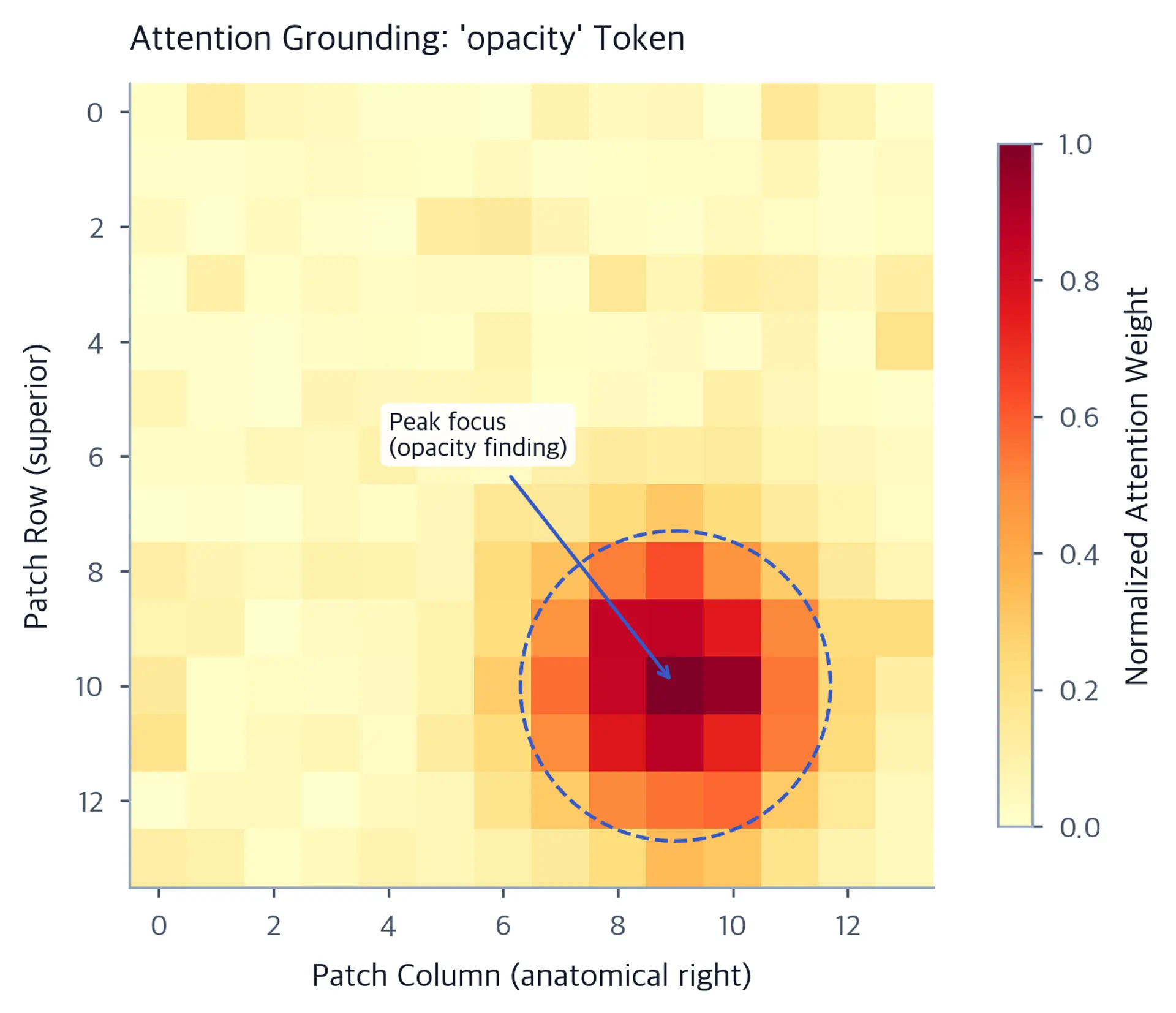 Heatmap of attention weights over a chest X-ray grid showing spatial focus on a specific region.